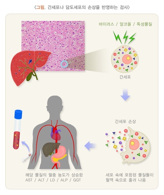 건강검진피검사항목 중 간 기능 검사인 AST, ALT, ALP 수치 상승과 간세포 손상 과정을 설명하는 일러스트